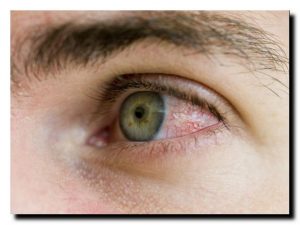 причины красных глаз у взрослого