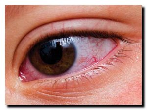 кровавые белки глаз