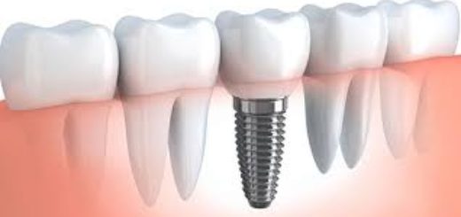 Имплантация зубов и уход за имплантами