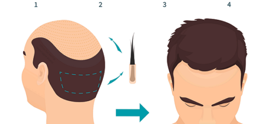 Пересадка волос по методу FUE